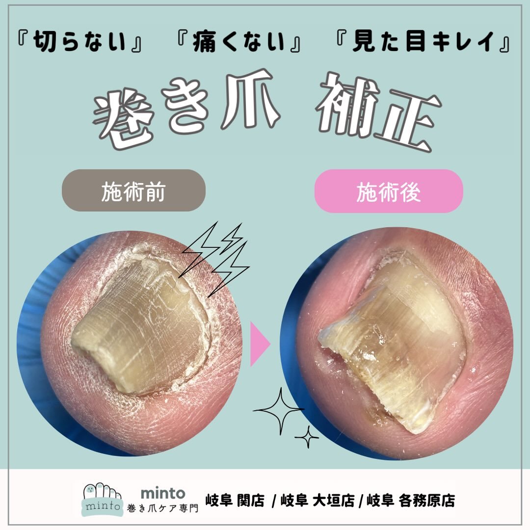 指に埋もれて刺さっていた爪を角質ケアと補正で引き上げた症例(minto公式Instagramより)