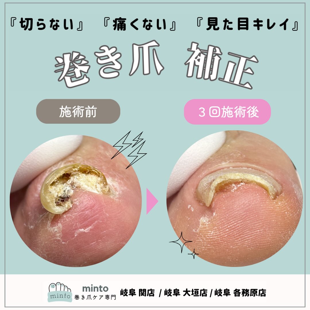 巻き爪補正の施術前と3回施術後の比較(minto公式Instagramより)